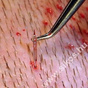 FUE graft kihúzása FUE graft kihúzása
